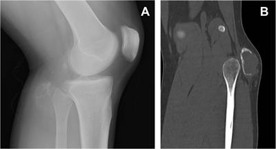 Case Report: Extraskeletal osteosarcoma with preceding myositis ossificans
